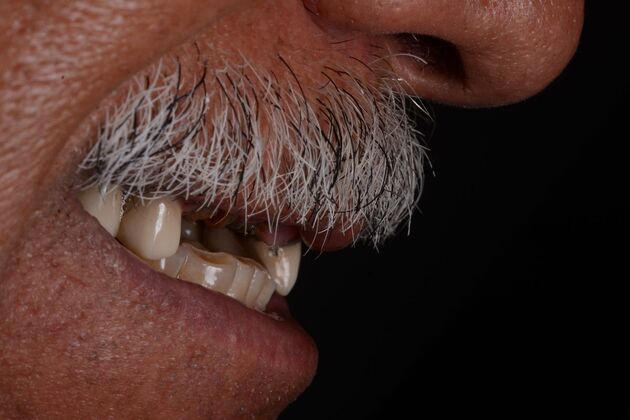 Our Results: UPPER ALL ON 6 TEETH IN A DAY - Before surgery