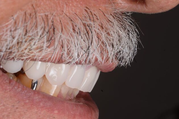 Our Results: UPPER ALL ON 6 TEETH IN A DAY - After surgery immediate load healing fixed temps