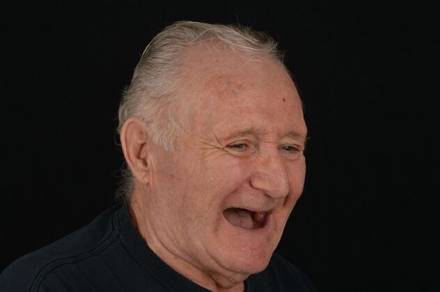 Our Results: ALL ON 4 TEETH IN A DAY - Before surgery