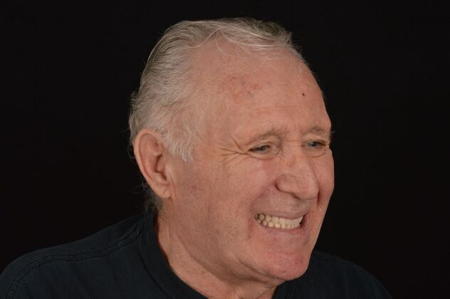 Our Results: ALL ON 4 TEETH IN A DAY - after surgery same day, teeth in a day lower fixed temps