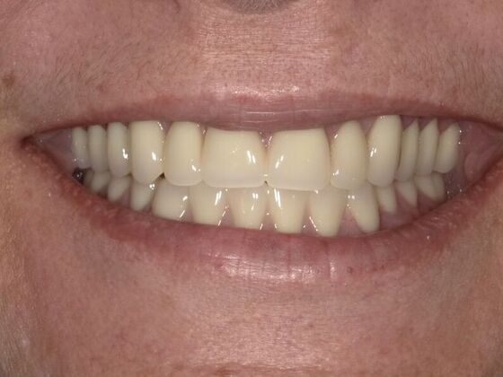 Dental Implant Dentures: Case 4 - After