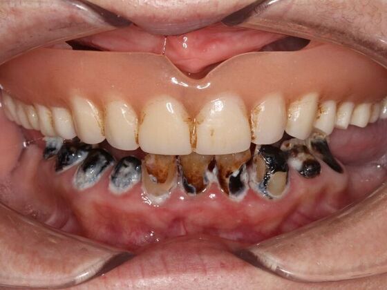 Dental Implant Dentures: Case 4 - Before