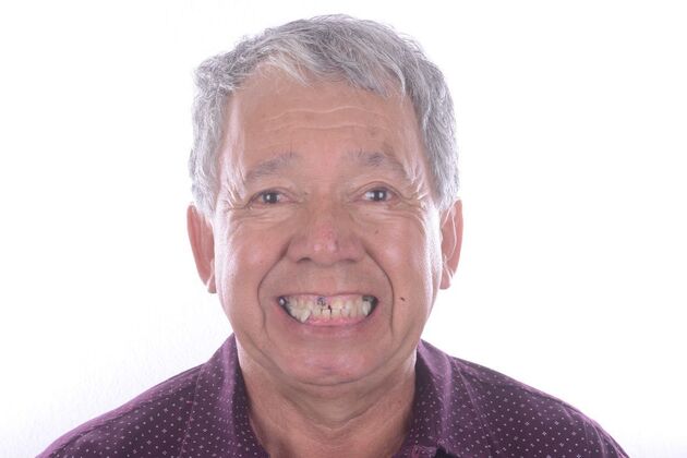 Our Results ALL ON 6 UPPER AND LOWER TEETH IN A DAY - Before