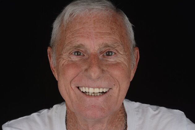 Our Results UPPER ALL ON 4 TEETH IN A DAY - After