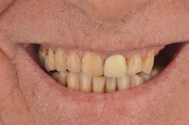 Our Results: UPPER ALL ON 4 TEETH IN A DAY - Before surgery