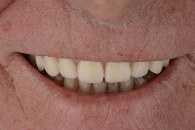 Our Results: UPPER ALL ON 4 TEETH IN A DAY - After surgery immediate load healing fixed temps