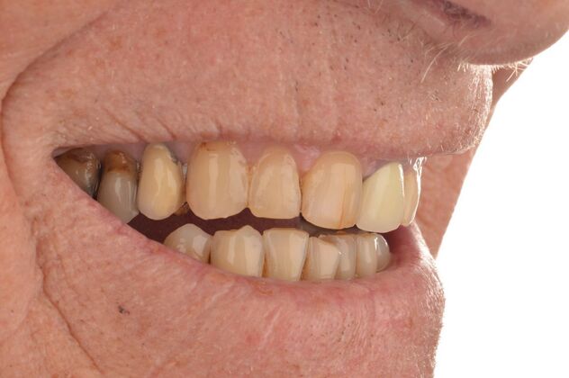 Our Results: UPPER ALL ON 4 TEETH IN A DAY - Before surgery