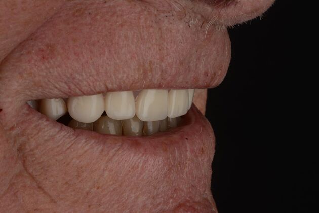 Our Results: UPPER ALL ON 4 TEETH IN A DAY - after surgery immediate load healing fixed temps