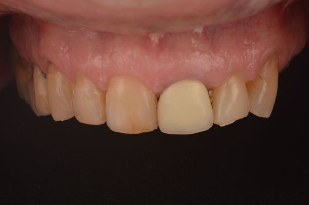 Our Results: UPPER ALL ON 4 TEETH IN A DAY - Before surgery