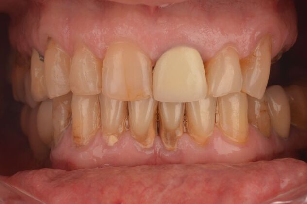 Our Results: UPPER ALL ON 4 TEETH IN A DAY - Before surgery