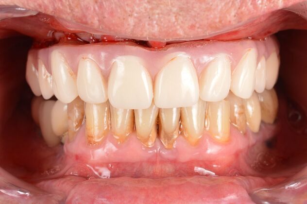 Our Results: UPPER ALL ON 4 TEETH IN A DAY - after surgery immediate load healing fixed temps