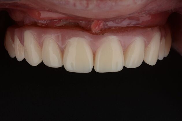 Our Results: UPPER ALL ON 4 TEETH IN A DAY - after surgery immediate load healing fixed temps