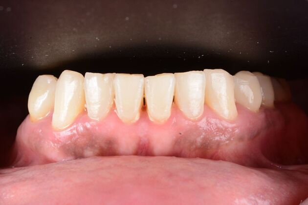 Our Results: LOWER ALL ON 6, TEETH IN A DAY, UPPER FULL MOUTH RECONSTRUCTION - Before surgery