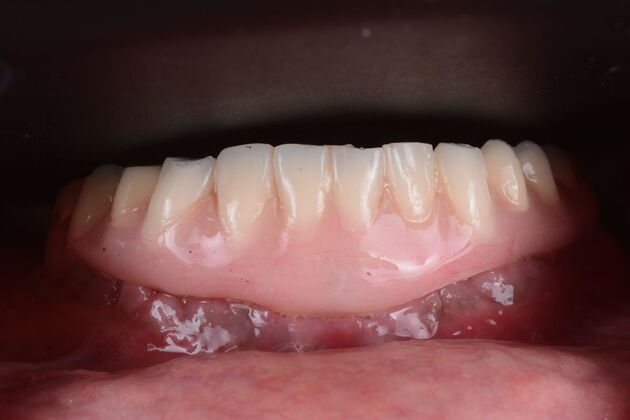 Our Results: LOWER ALL ON 6, TEETH IN A DAY, UPPER FULL MOUTH RECONSTRUCTION - after surgery immediate load healing lower fixed temps
