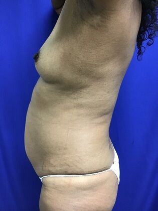 Body Buttock Enhancement: Case 9 (1316) - Before