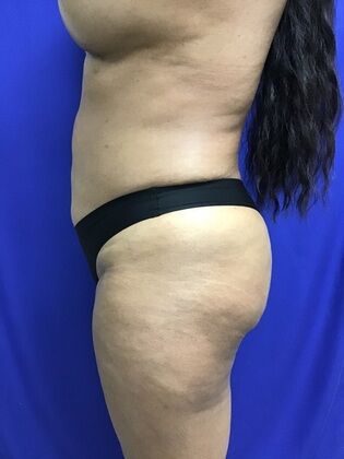 Body Buttock Enhancement: Case 9 (1316) - After