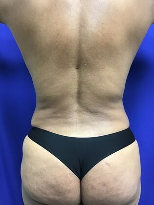 Body Buttock Enhancement: Case 9 (1316) - After