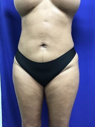 Body Liposuction: Case 11 (1316) - After lipo tummy and flanks