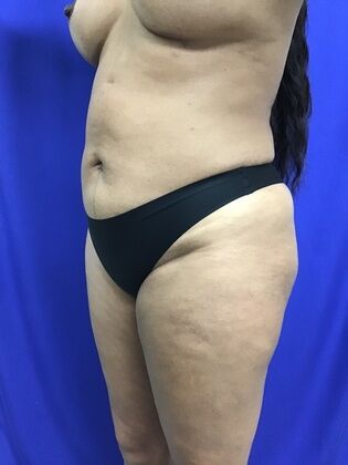 Body Liposuction: Case 11 (1316) - After