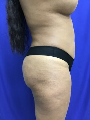 Body Liposuction: Case 11 (1316) - After flatter tummy, narrower waist, rounder butt