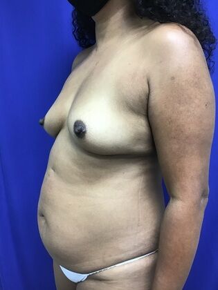 Body Liposuction: Case 11 (1316) - Before