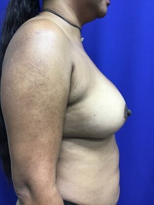 Body Liposuction: Case 11 (1316) - After implants