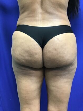 Body Liposuction: Case 11 (1316) - After