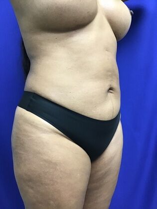 Breast Augmentation : Case 82 (1316) - After