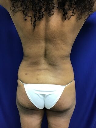 Breast Augmentation : Case 82 (1316) - Before