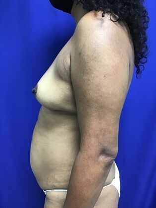 Breast Augmentation : Case 82 (1316) - Before