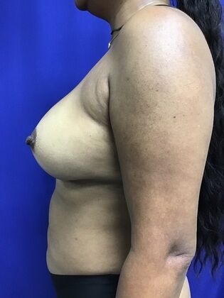 Breast Augmentation : Case 82 (1316) - After