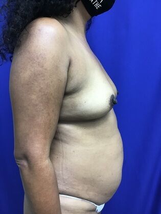 Breast Augmentation : Case 82 (1316) - Before