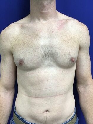 Male Breast / Gynecomastia Case 7 (2545863) - After