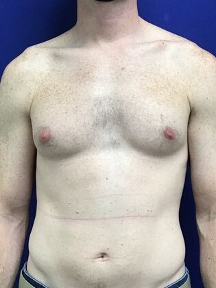 Male Breast / Gynecomastia Case 7 (2545863) - Before