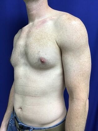 Male Breast / Gynecomastia: Case 7 (2545863) - After