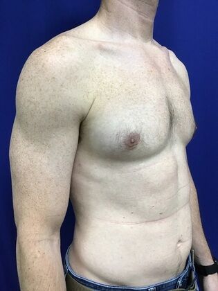 Male Breast / Gynecomastia: Case 7 (2545863) - After