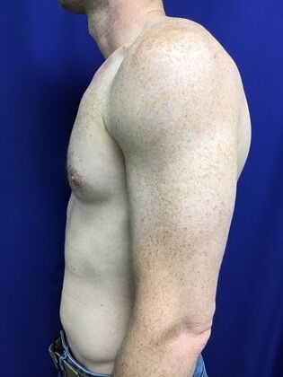 Male Breast / Gynecomastia: Case 7 (2545863) - After