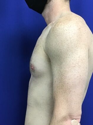 Male Breast / Gynecomastia: Case 7 (2545863) - Before