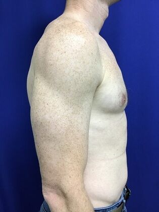 Male Breast / Gynecomastia: Case 7 (2545863) - After