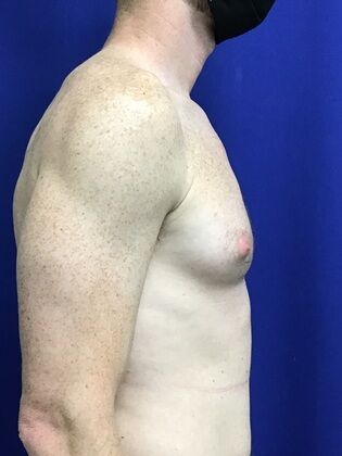 Male Breast / Gynecomastia: Case 7 (2545863) - Before