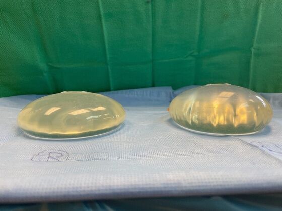 Breast Lift / Mastopexy: Case 40 (2491591) - Old implants, left filled fuller because her left breast was naturally smaller