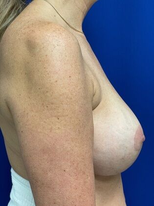 Breast Lift / Mastopexy: Case 40 (2491591) - After