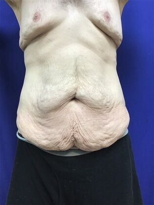 Male Body Contouring Case 5 (1711736) - Before