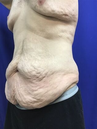 Male Body Contouring: Case 5 (1711736) - Before