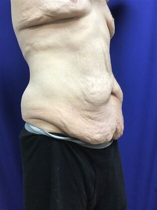 Male Body Contouring: Case 5 (1711736) - Before