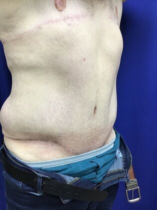 Male Body Contouring: Case 5 (1711736) - After