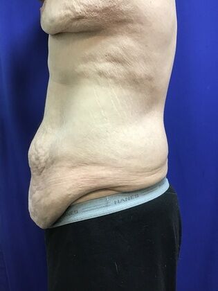 Male Body Contouring: Case 5 (1711736) - Before