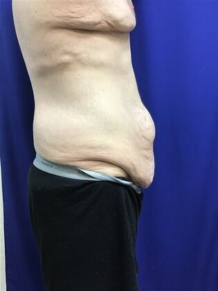 Male Body Contouring: Case 5 (1711736) - Before