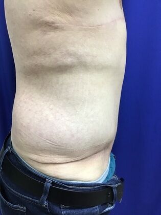 Male Body Contouring: Case 5 (1711736) - After, posture improved with abdominal muscle tightening