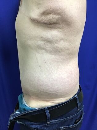Male Body Contouring: Case 5 (1711736) - After